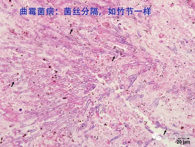 毛霉菌银染