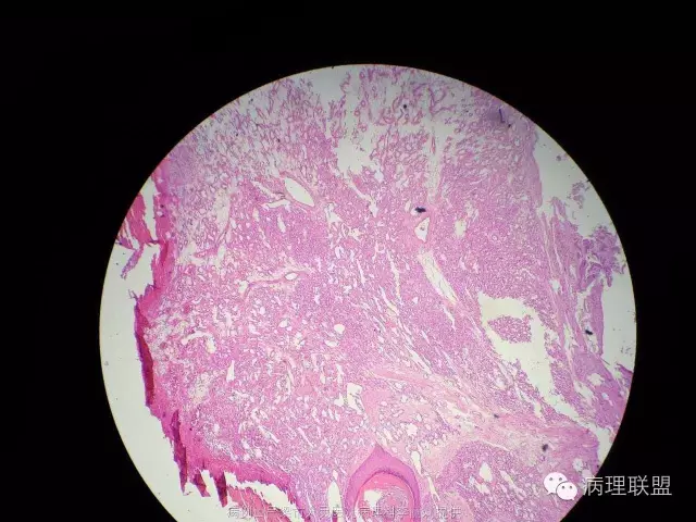 ▼ 答疑▼ 南医大病理 邓永键教授: 化脓性肉芽肿即肉芽组织型血管瘤