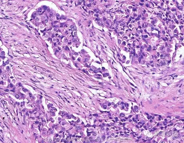 ▼低分化腺癌的较强破坏力3▼▼破坏力轻度▼▼张力-空泡征▼▼胸膜