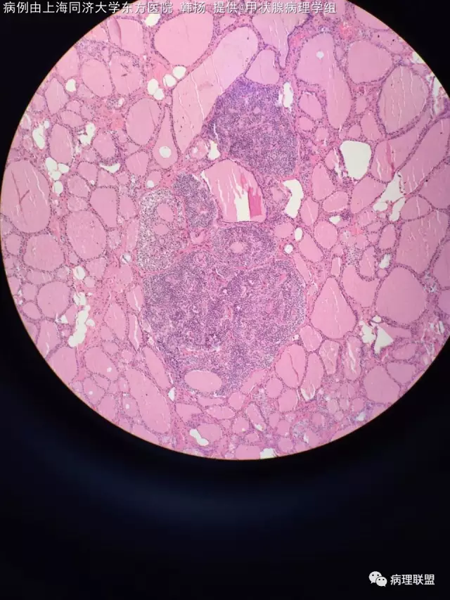 镜下还发现实性细胞巢团上海同济大学东方医院 韩扬ptc武警总队嘉兴